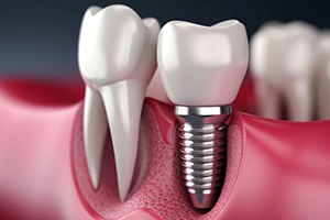 Illustration of dental implant in jawbone next to natural tooth