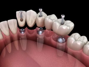 Illustration of a multi-unit dental implant bridge